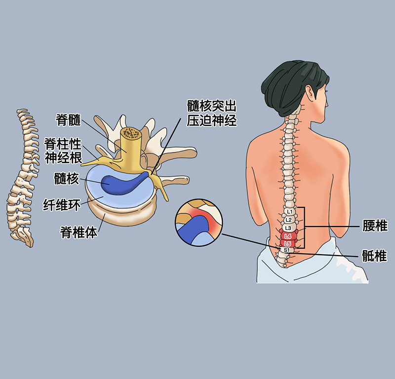 腰椎間盤(pán)突出如何預(yù)防？